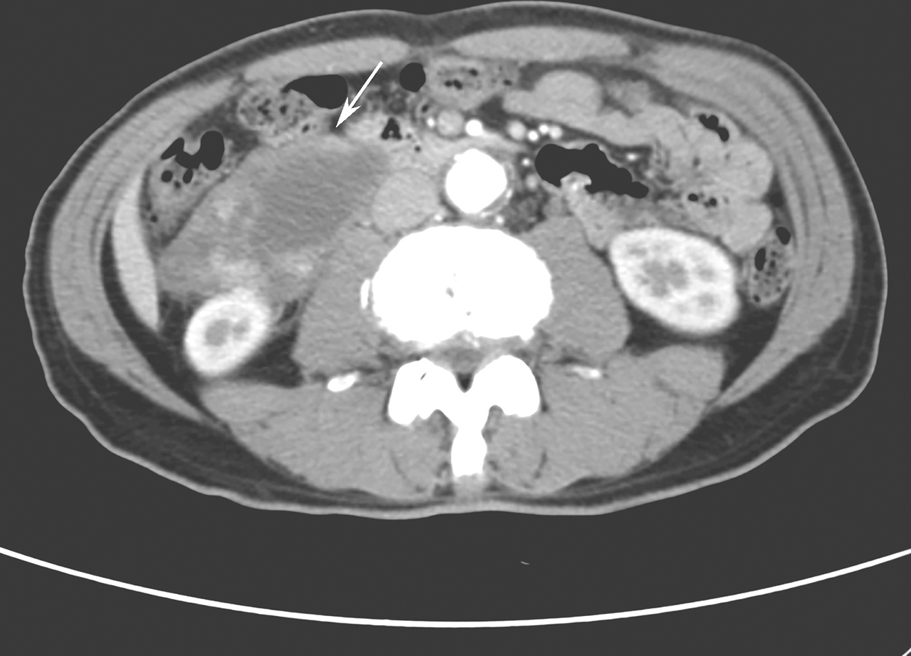 图2 服药4个月后腹部增强CT